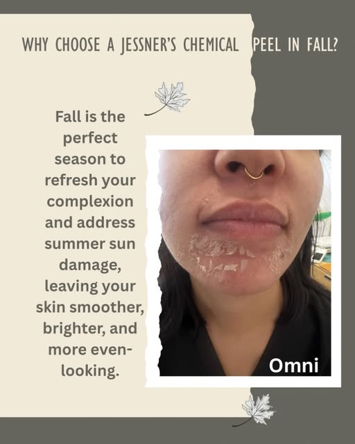 Why choose a Jessner Plus chemical Peel in Fall?

Improves uneven skin tone and pigmentation

 ✨ Hel