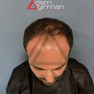 ADEMAĞIRMAN HAİRTRANSPLANT
https://www.ademagirman.com

#saçekimi #sakalekimi #hairtransplant 
#adem