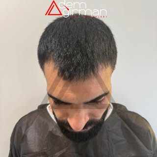 ADEMAĞIRMAN HAİRTRANSPLANT
https://www.ademagirman.com

#saçekimi #sakalekimi #hairtransplant 
#adem