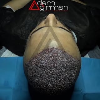 ADEMAĞIRMAN HAİRTRANSPLANT
https://www.ademagirman.com

#saçekimi #sakalekimi #hairtransplant 
#adem