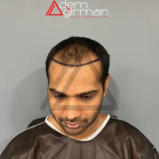 ADEMAĞIRMAN HAİRTRANSPLANT
https://www.ademagirman.com

#saçekimi #sakalekimi #hairtransplant 
#adem