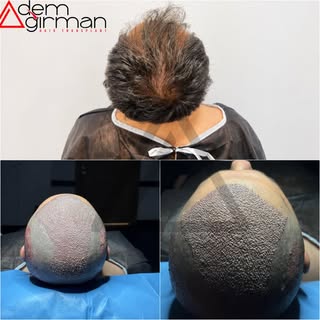 ADEMAĞIRMAN HAİRTRANSPLANT
https://www.ademagirman.com
#saçekimi #sakalekimi #hairtransplant 
#adema