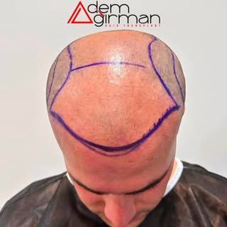 ADEMAĞIRMAN HAİRTRANSPLANT
https://www.ademagirman.com
#saçekimi #sakalekimi #hairtransplant 
#adema
