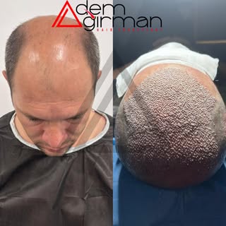 ADEMAĞIRMAN HAİRTRANSPLANT
https://www.ademagirman.com
#saçekimi #sakalekimi #hairtransplant 
#adema