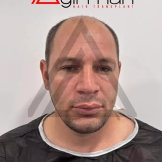 ADEMAĞIRMAN HAİRTRANSPLANT
https://www.ademagirman.com
#saçekimi #sakalekimi #hairtransplant 
#adema