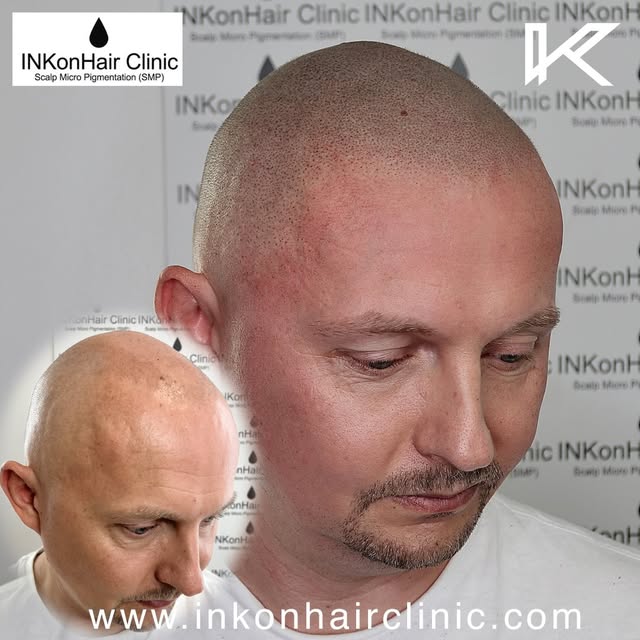 💥HYPER NATURAL SMP TRANSFORMATION💥
It was great to help this top fella! 🙏🤩

- ULTRA NATURAL SOFT