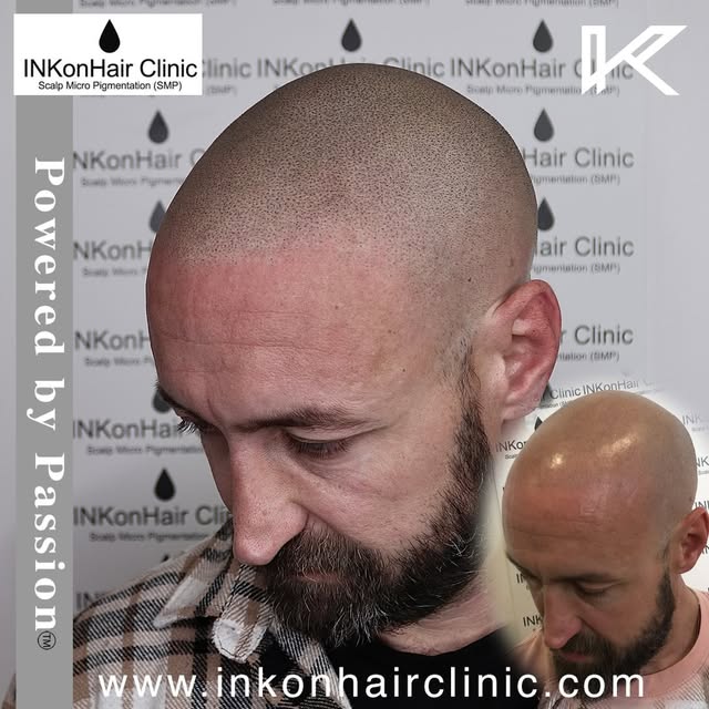 Get your confidence back in 2026 & Say BYE 🙋‍♂️👋🏻 to hair loss for good with world class SMP (hai