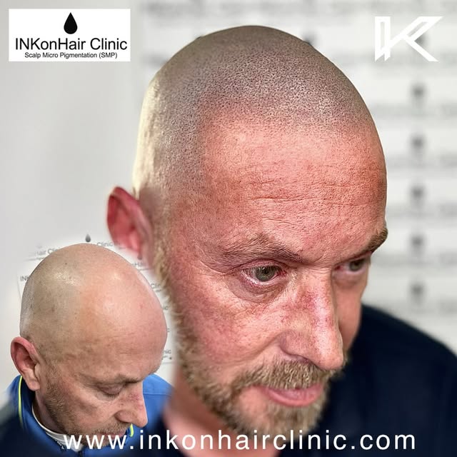 ✨ Ready for a Hair Transformation? ✨
Experience the magic of Scalp Micropigmentation (SMP) with Ink 