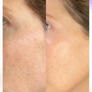 Happy Monday! One of the best ways to treat pigmentation issues is with IPL laser treatment, here’s 
