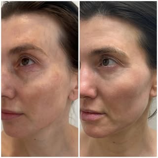 We’re really happy with our patients results two weeks out from a fractionated ablative Co2. The fra