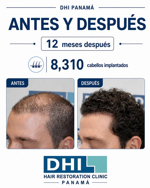Mira la línea frontal. Ahora mira la densidad. 👀

El objetivo de un buen trasplante capilar no es s
