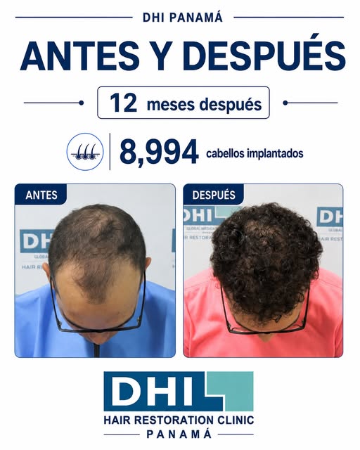 De una pérdida capilar avanzada a recuperar cobertura en prácticamente toda la zona superior.

Este 