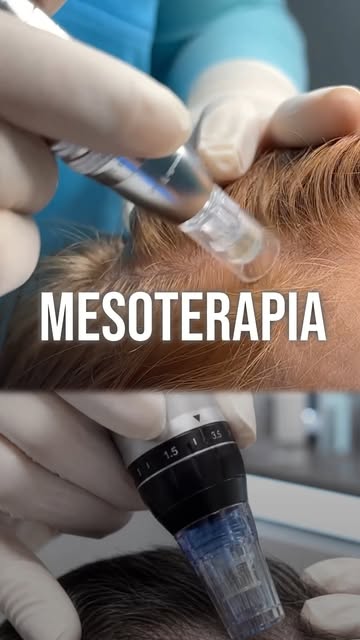 ¿Tu cabello necesita un impulso? 💉✨

La mesoterapia capilar con Dermapen crea microcanales que favo