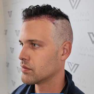 Before ➜ 6 months after 1743 grafts ✨

A more defined, natural hairline while keeping his original c