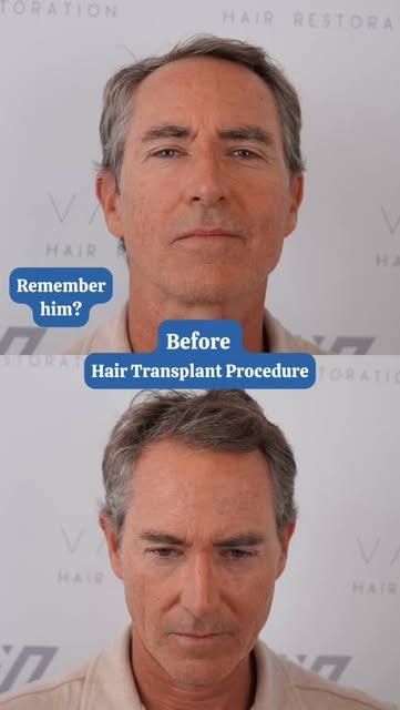 Some patient stories stick with you.

Not because of the number of grafts or how much the hairline c