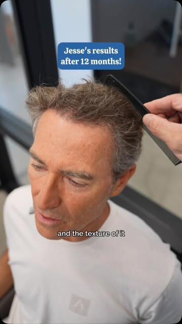 This is the kind of follow-up conversation I love having.

The questions before a hair transplant ar