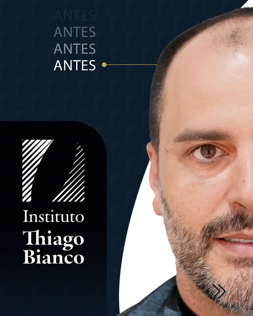 A harmonia facial começa na hairline.

Para Danilo Marques Antonangelo, a redefinição de sua linha f