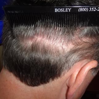 Talk about a fine line! No need to fear the linear scar from FUT. It is still a great procedure in t