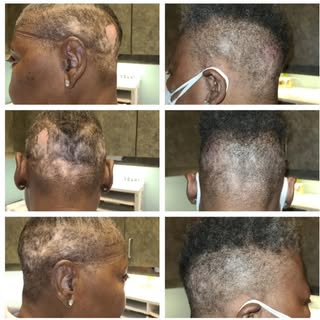 After just 1 session, alopecia patches are already looking better. 1 more to go...

Scalp Micropigme