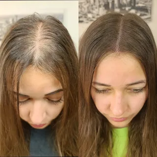 Final session on this lovely lady. Scalp Micropigmentation Microblading on female with thinning hair