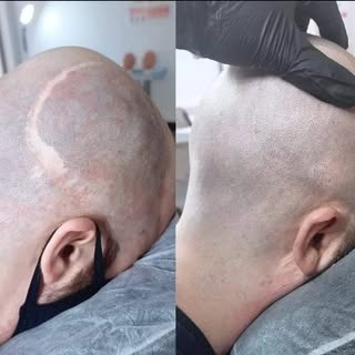 He was attacked and needed brain surgery. Then we covered the scar up with Scalp Micropigmentation. 