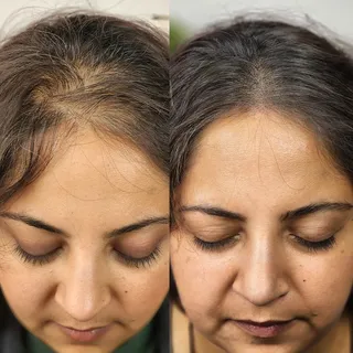 Scalp Micropigmentation for Female Hairloss. Building density over multiple sessions, using a variet