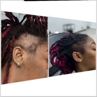 Scalp Micropigmentation for Women at our San Antonio location. Whether you have traction alopecia, t