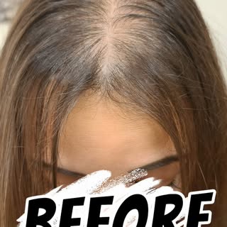 Female Hair Loss? ScalppFem was the first SMP clinic in the world  dedicated solely on treating Fema