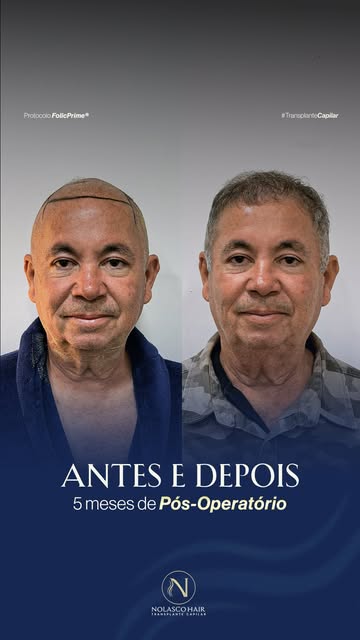 Só 5 meses — e o antes já conta outra história. 👀

LEGENDA

Quando colocamos o antes ao lado de com