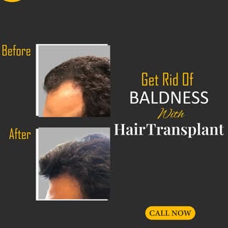 Get Rid of Baldness with a Natural Hairline

Struggling with a receding hairline or temple baldness?