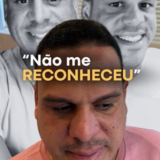 Dois anos após o transplante capilar e o resultado é tão impressionante que nem a própria
avó reconh