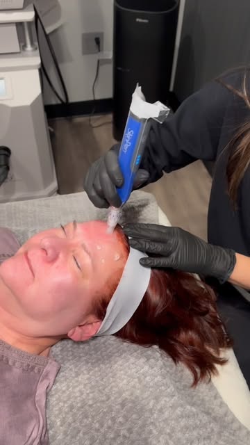 Microneedling is one of our favorite treatments here at Vixen! 

By creating tiny, controlled micro-