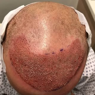 Full frontal correction 3300 hairs