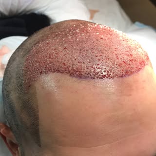 Full frontal and crown correction, medium density 4000 hairs.