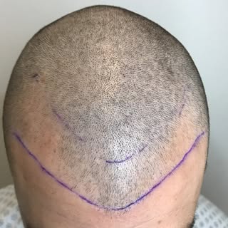 Only 5 months post op. Our client is seeing amazing results already from our micro FUE hair transpla