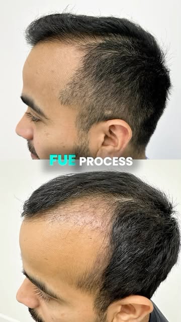 Part 1. 2,000 grafts. But the biggest change wasn’t just his hair.
At 25, Utkarsh underwent an FUE h