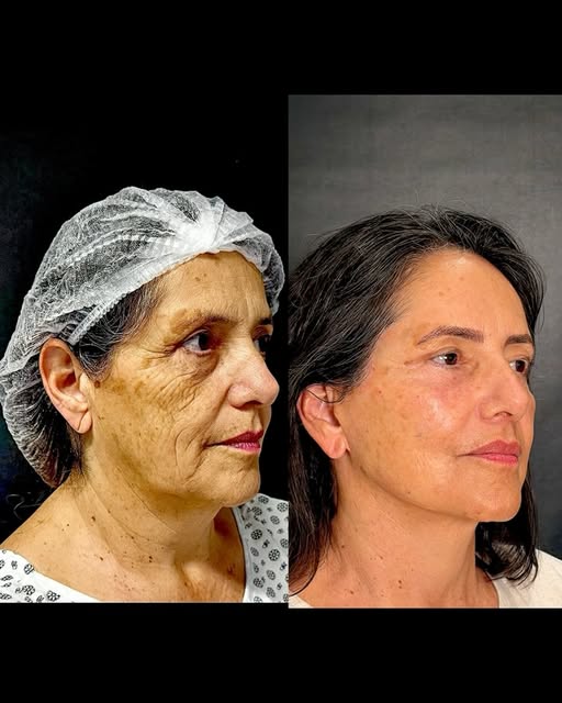O rejuvenescimento facial vai muito além de “esticar a pele”.

Com o passar dos anos, diferentes est