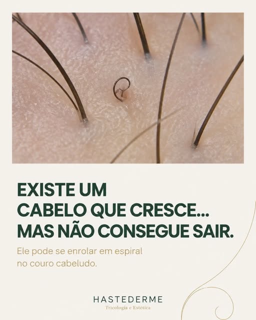 Você sabia que existe cabelo em espiral?

Também chamado de rolled hair, ele pode surgir quando o fi