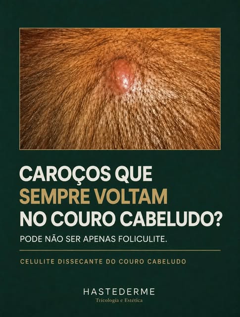 Você tem caroços no couro cabeludo que inflamam, doem e sempre voltam?

Esse pode ser um sinal de ce