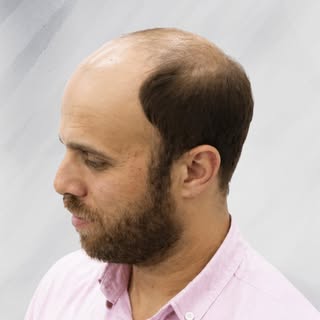 من الفراغ إلى الكثافة.. تحول جذري يمنحك مظهراً أصغر سناً وأكثر جاذبية. نستخدم أحدث التقنيات لضمان نت
