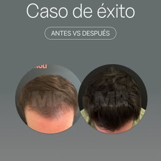 ¿Ves esa mejora de densidad en la zona frontal? 👀✨⁣
⁣
Esto NO es cirugía. Es un tratamiento médico 