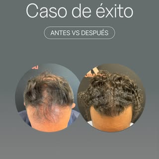 Un año puede cambiarlo todo en tu pelo. 👀✨⁣
En la primera imagen ves el “antes”: entradas marcadas 