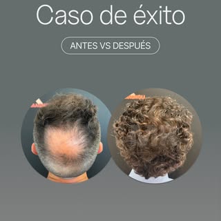 Un año después de su cirugía de injerto capilar 🔍⁣
 ⁣
Este es el resultado real de nuestro paciente