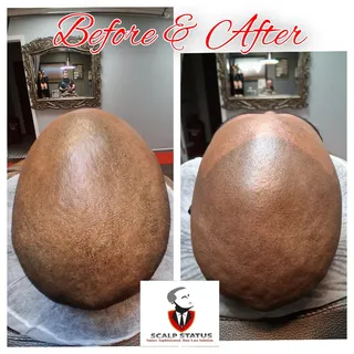 Incredible results with Scalp Micro Pigmentation.Now this session was achieved with four sessions du