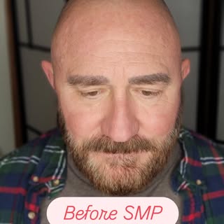 Scar Camouflage, pigmentation correction and on with life💯 #eddielopez #smpdenver #hairtattoo #scal