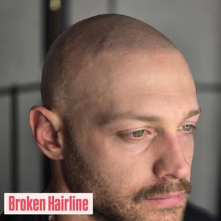 Hairloss can be devastating. With SMP, you have options no matter what skin or hair type.  #eddielop