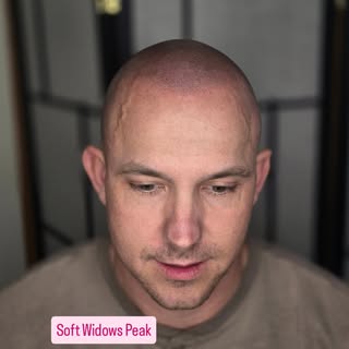 Another realistic hairline... mimicking a soft widows peak.  Some clients ask for hairlines that are
