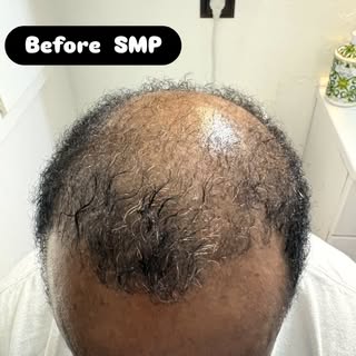 This gentleman came to us from the hair system world.  He grew tired of the process and costs.  He w
