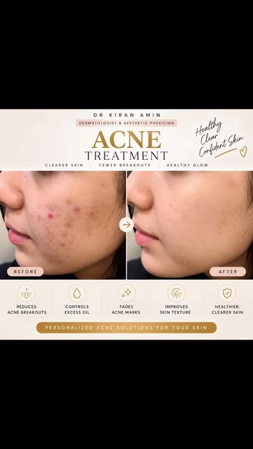 ✨ Clearer Skin. Fewer Breakouts. Renewed Confidence.

Introducing Dr. Kiran Amin’s Signature Acne Tr