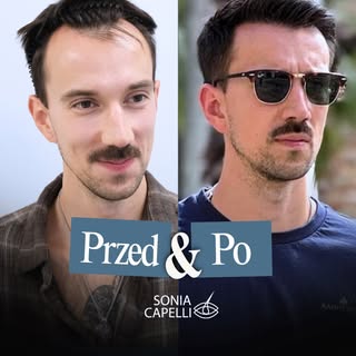Efekty przeszczepu włosów to nie tylko kwestia wyglądu. To odzyskanie kontroli i poczucie bycia najl